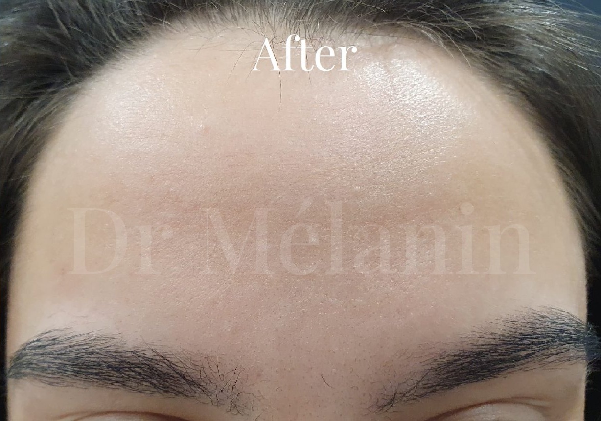 The same forehead two weeks after anti-wrinkle treatment, with lines visibly softened