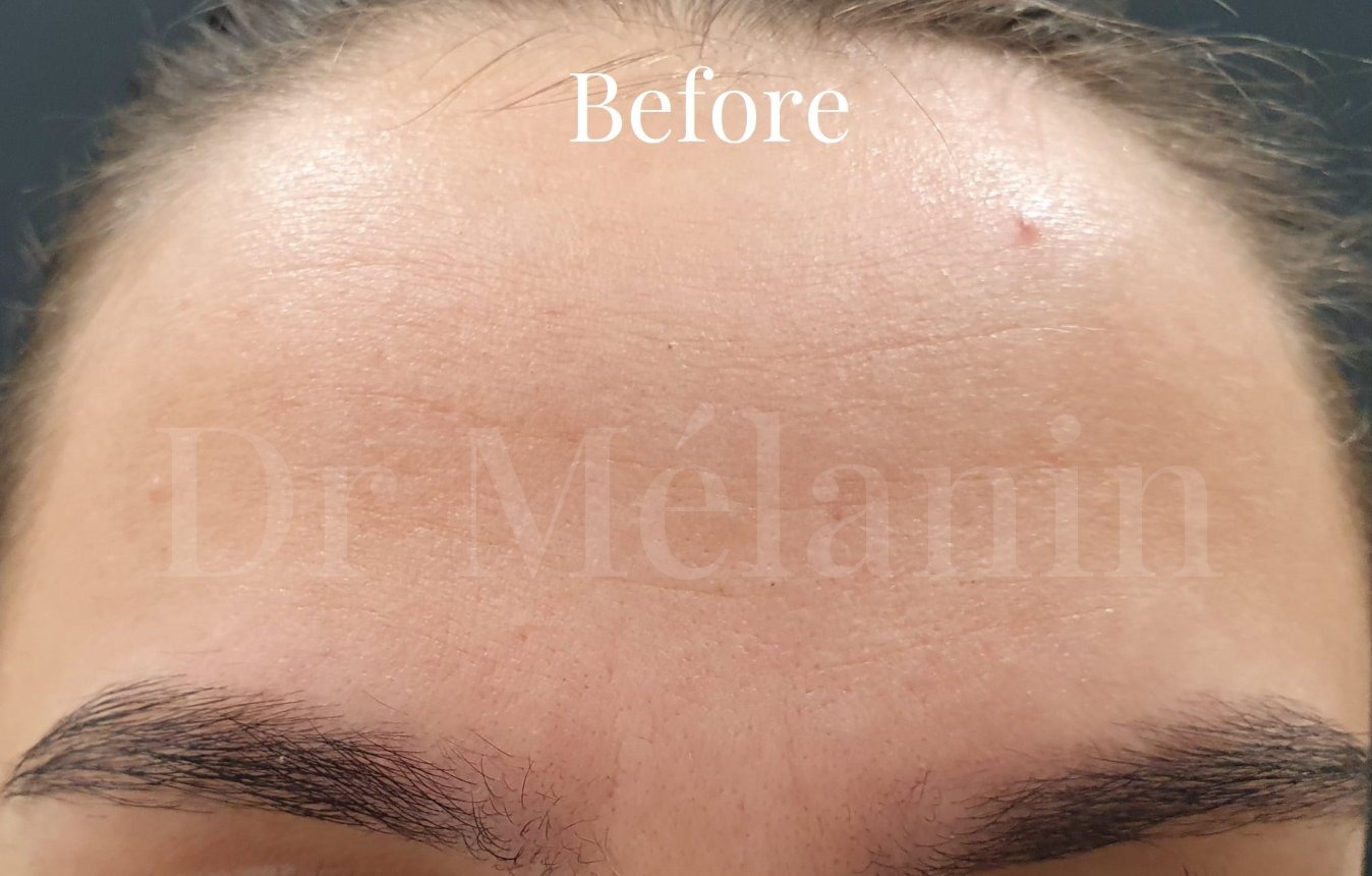 Forehead before anti-wrinkle treatment, with visible horizontal lines