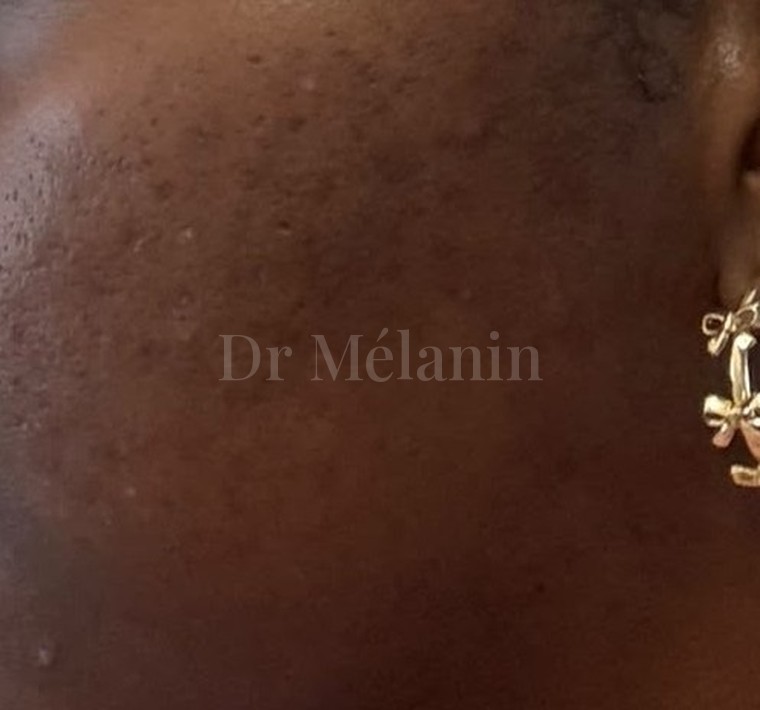 The same cheek after six chemical peels, with clearer, smoother skin