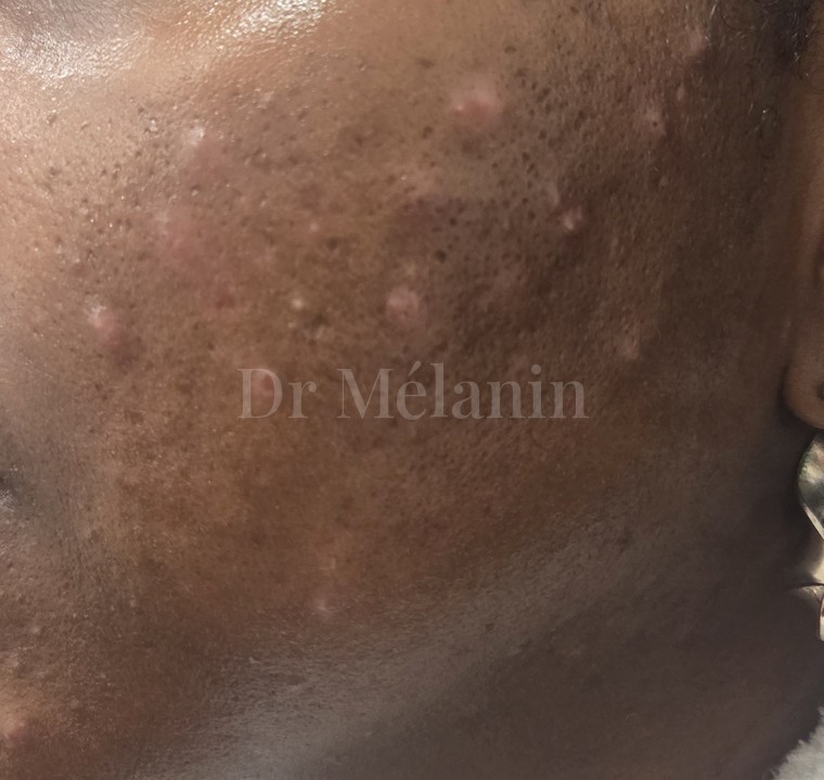 Cheek before treatment, with active breakouts and dark marks