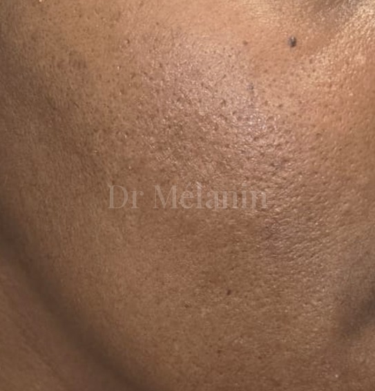 The same cheek after six chemical peels, with smoother texture and a more even tone