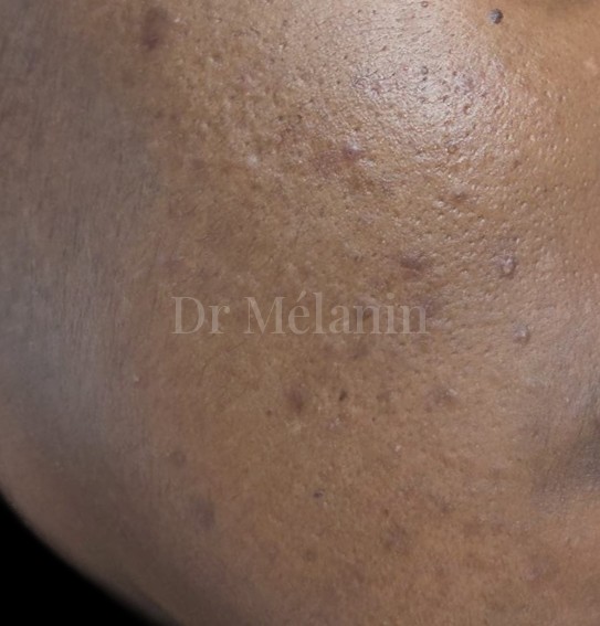 Cheek before treatment, with uneven texture and dark marks