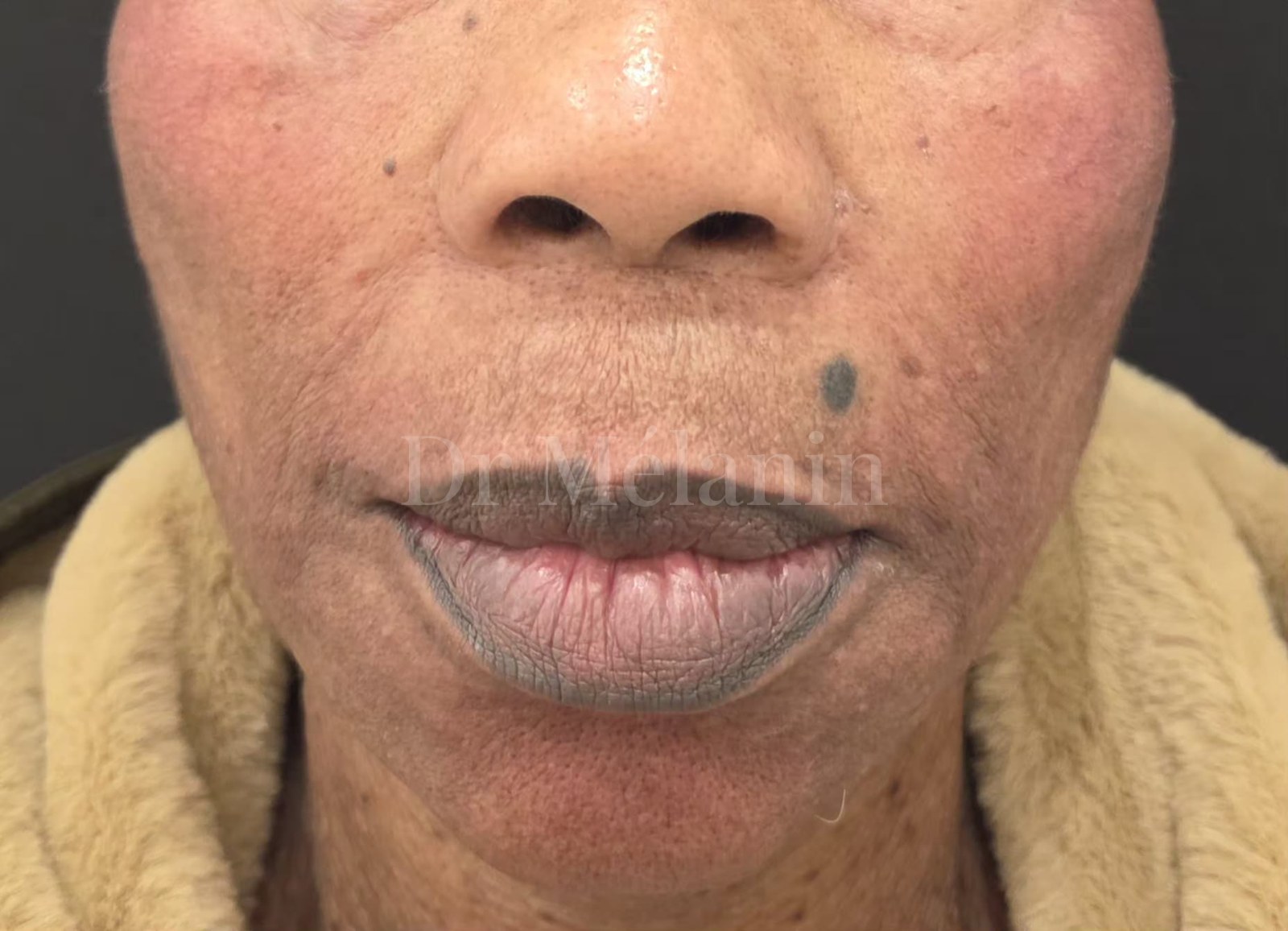 Front view of the lower face immediately after treatment