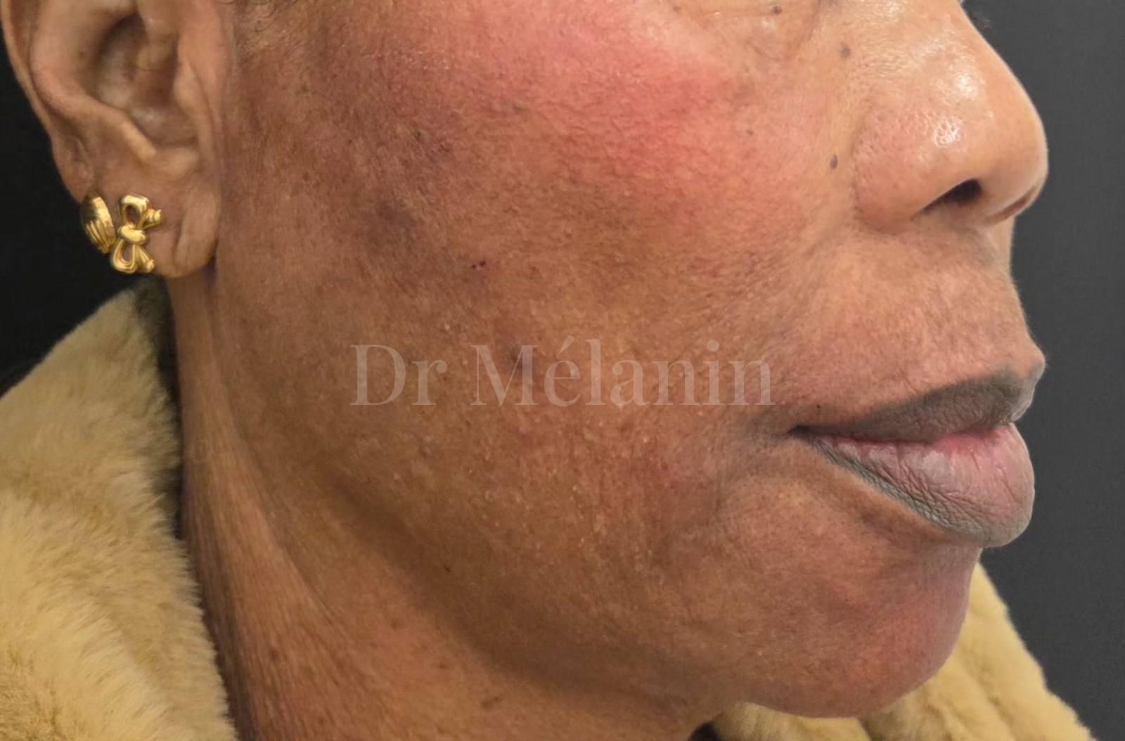 The same view immediately after treatment, with restored volume and softer lines