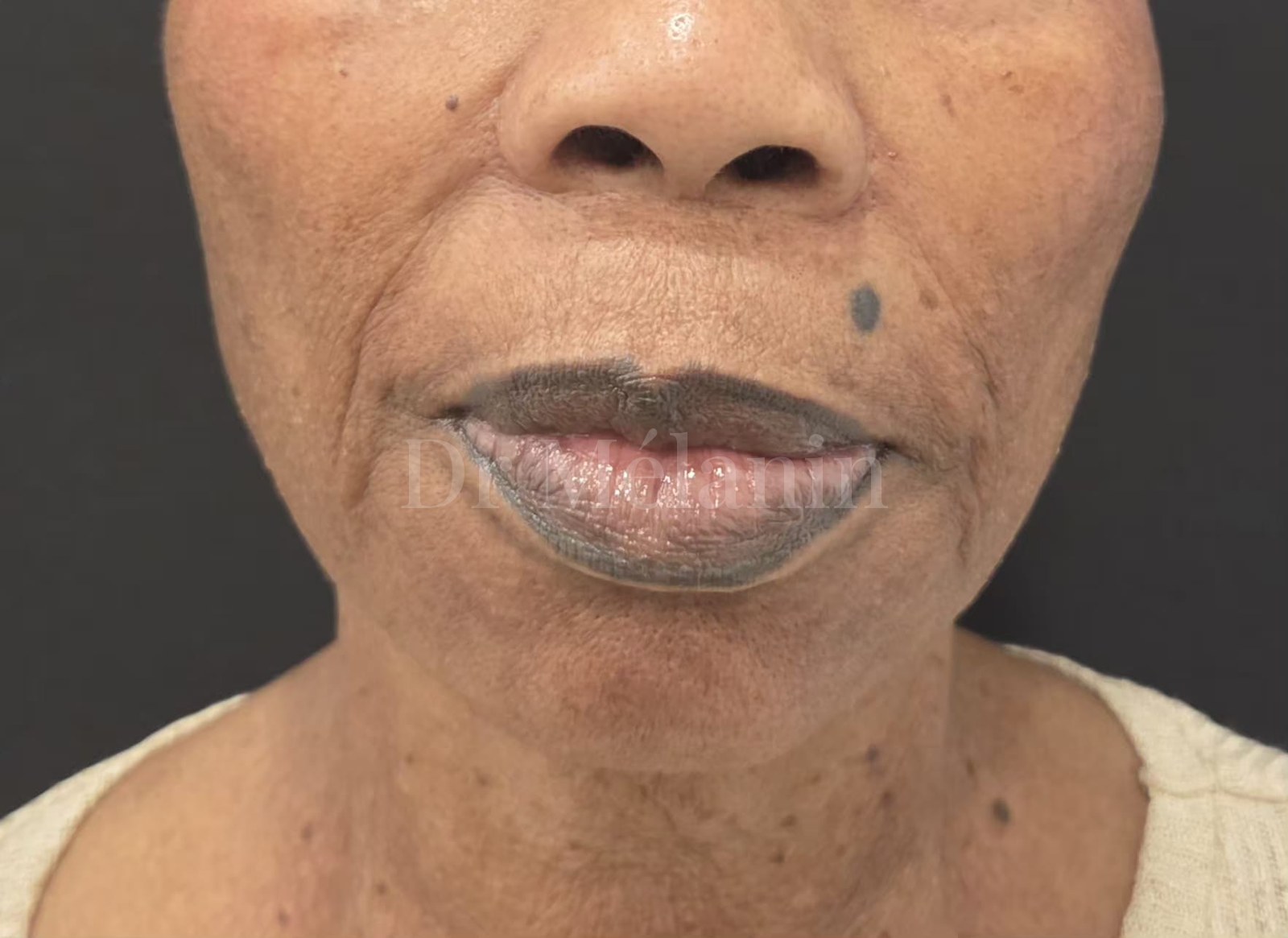 Front view of the lower face before treatment