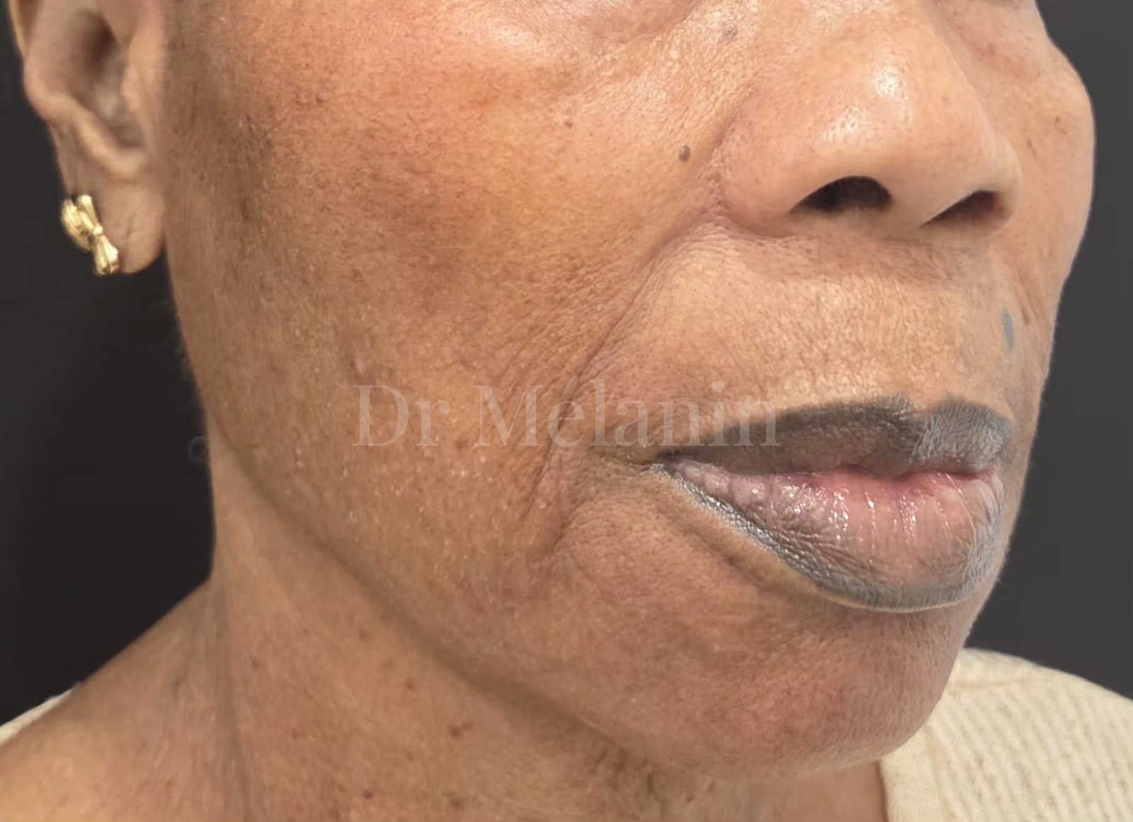 Three-quarter view before treatment, showing volume loss and lines around the mouth