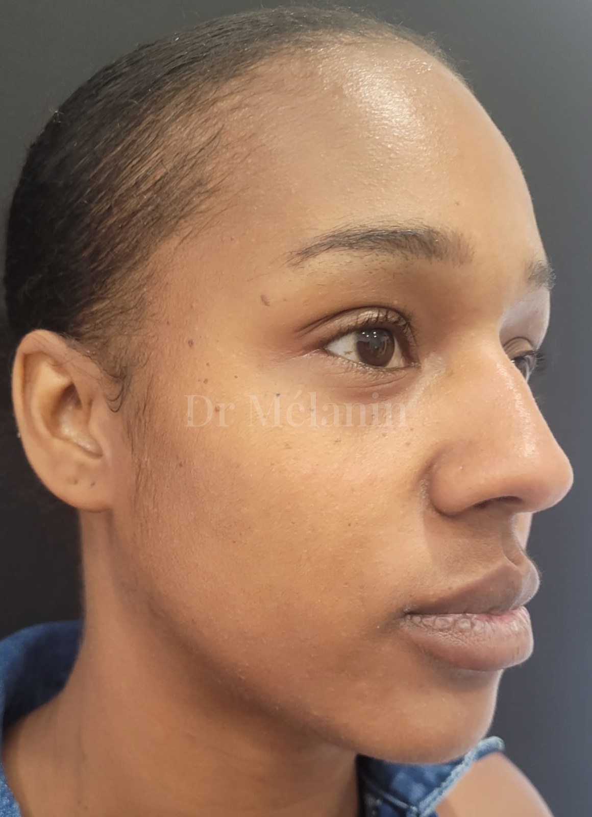 The same view after cheek filler, with gently restored cheek support