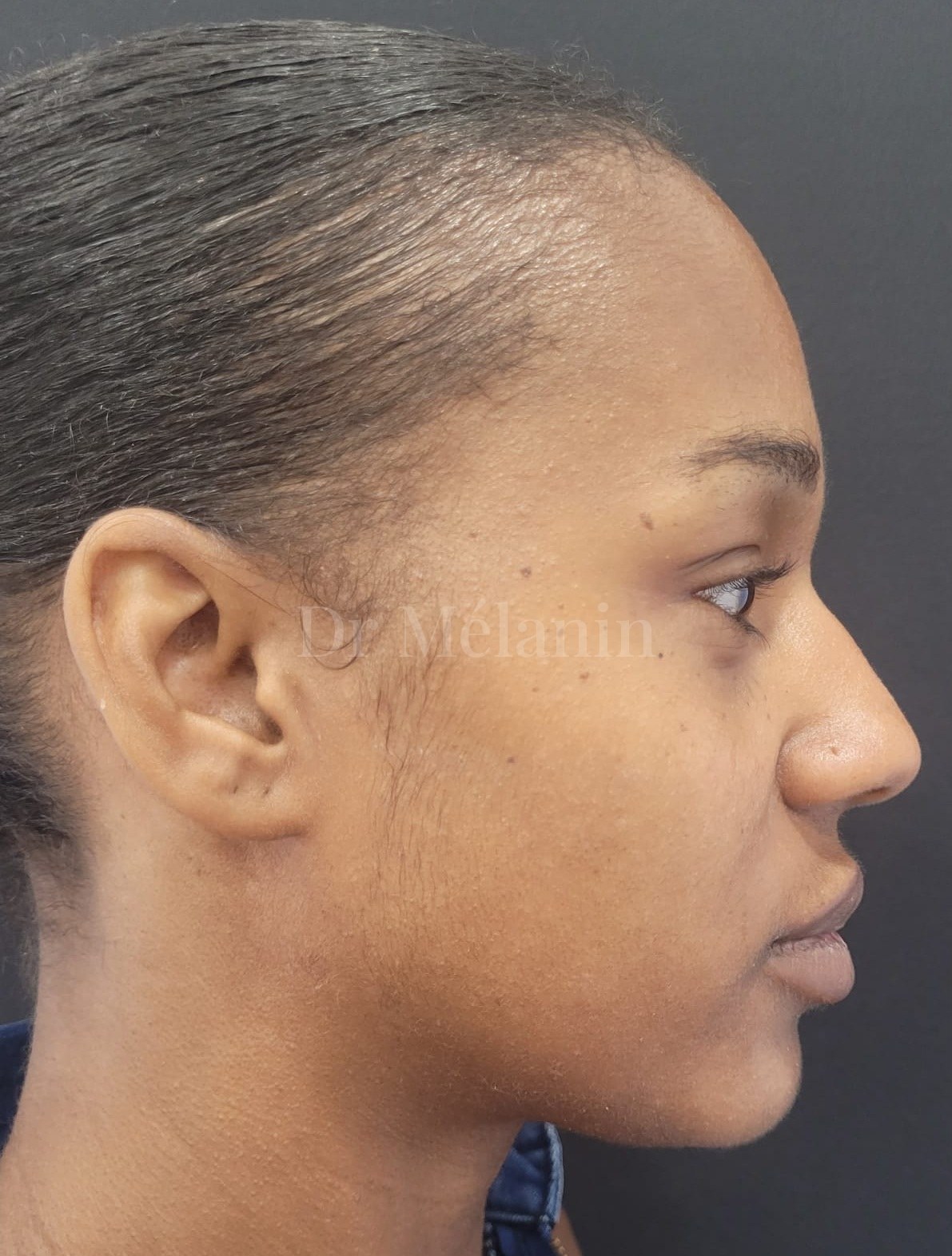 Side profile after cheek filler