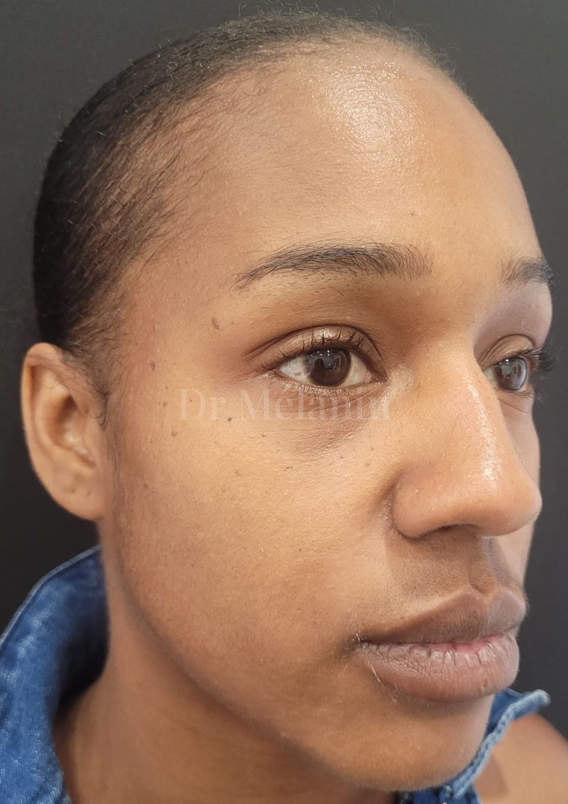 Three-quarter view before cheek filler