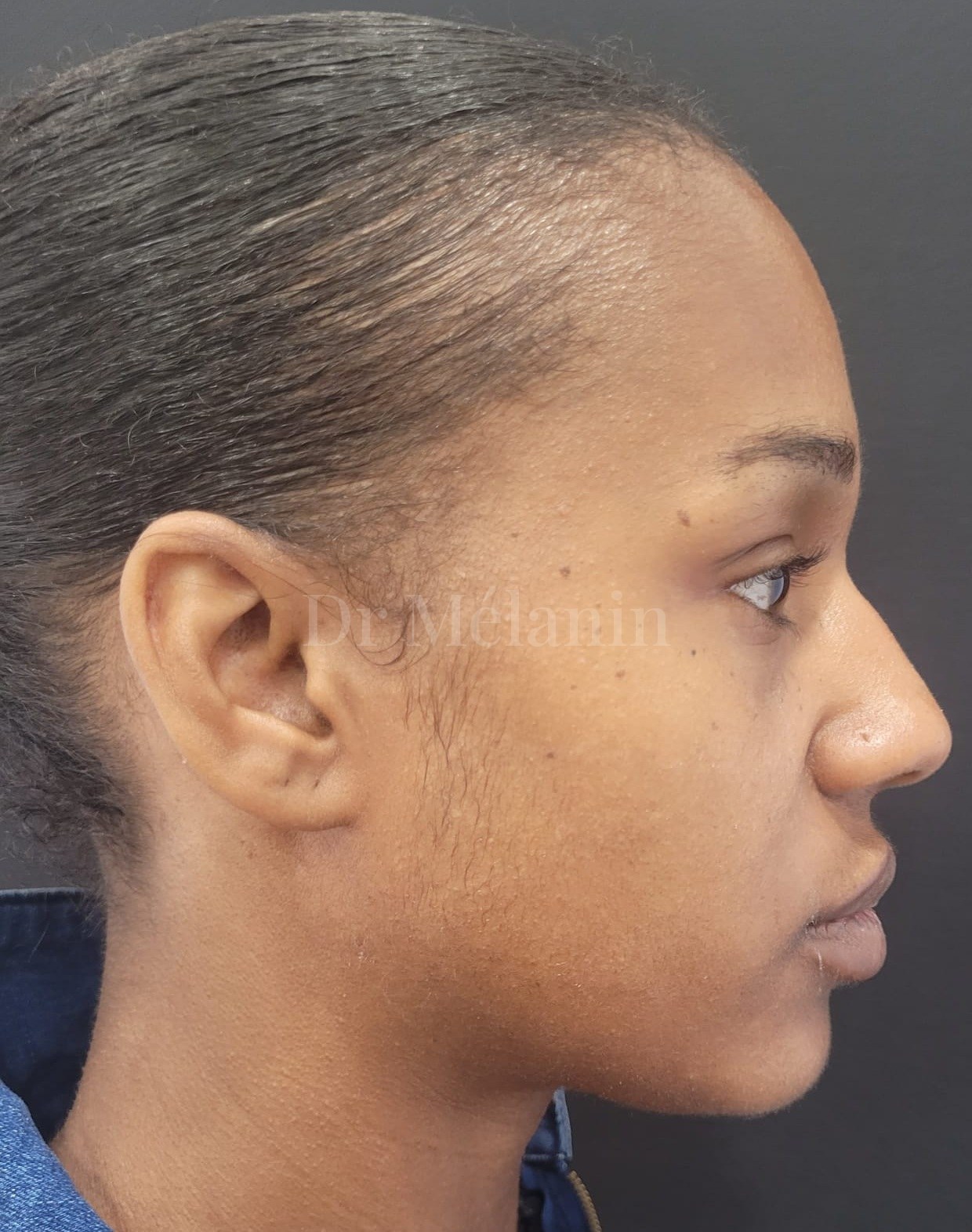 Side profile before cheek filler
