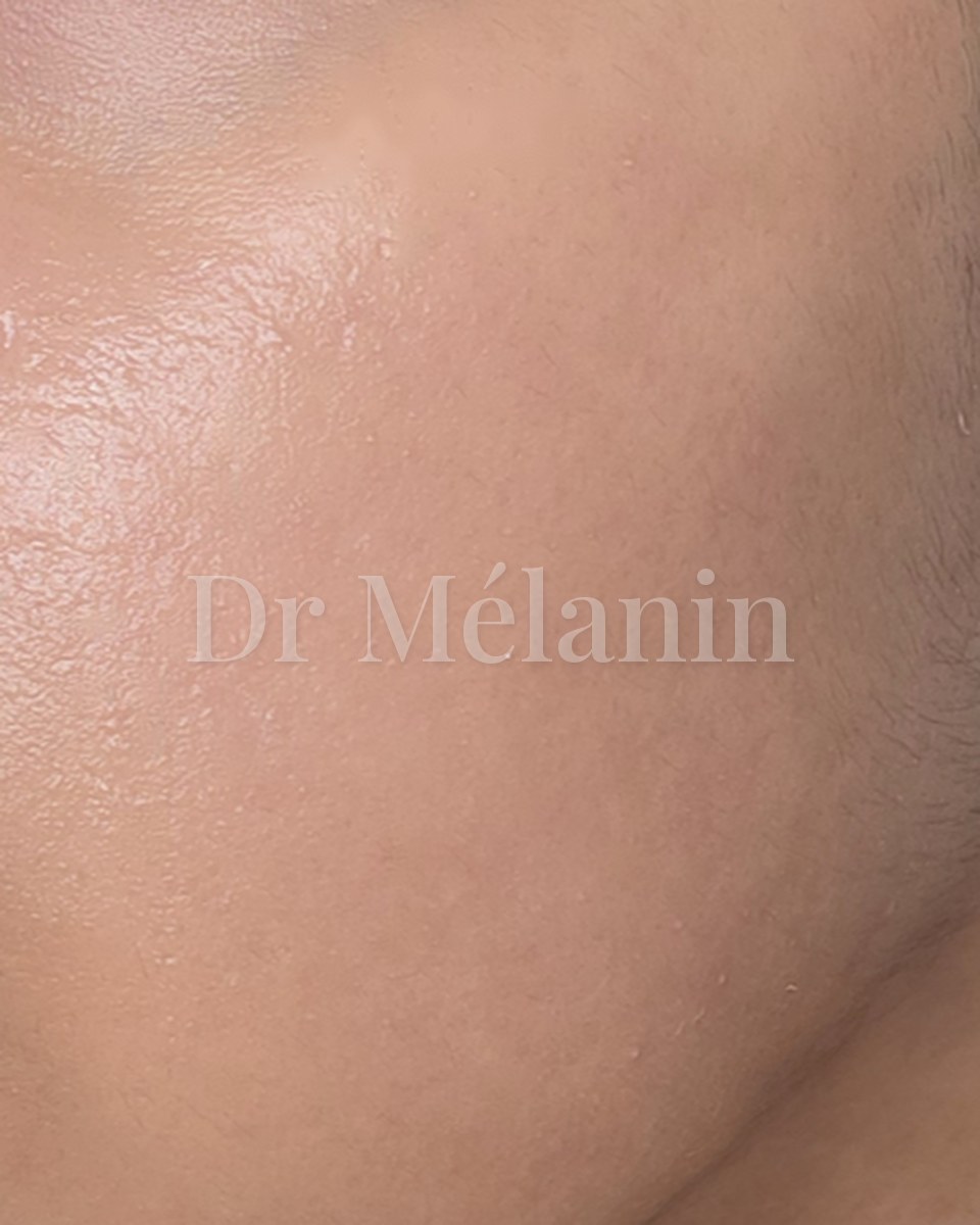 The same cheek after treatment, with smoother, calmer and more even skin