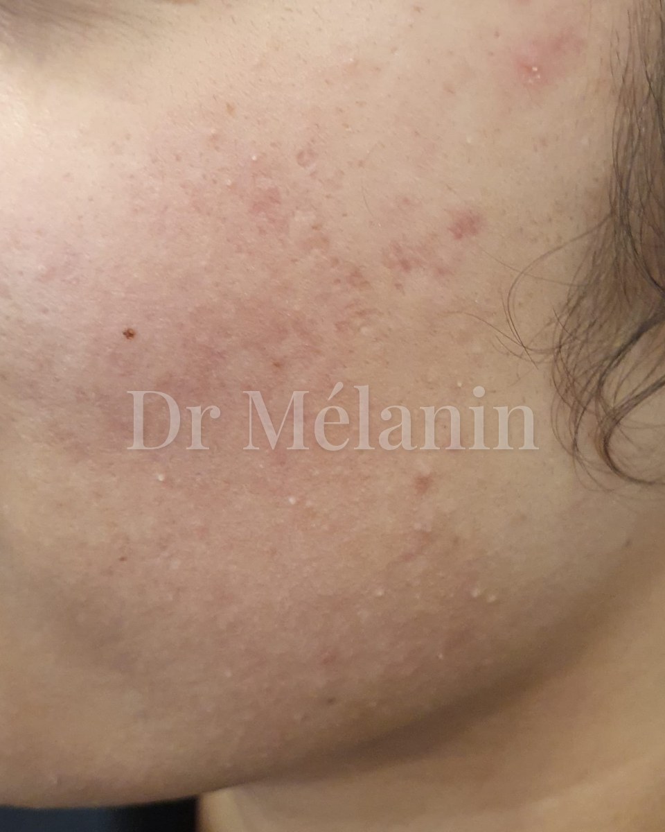 Cheek before treatment, with redness, breakouts and uneven texture