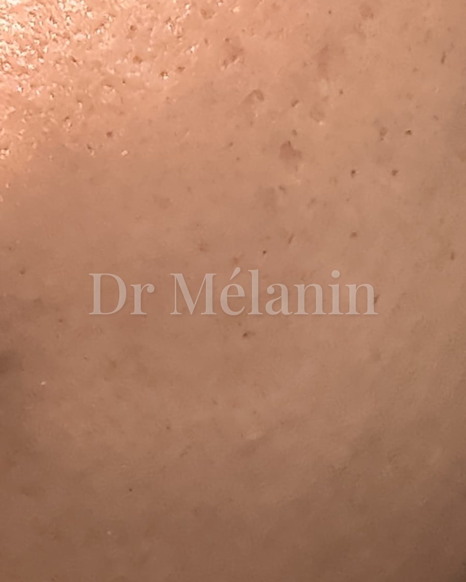 The same cheek after three microneedling sessions, with clearer, smoother skin