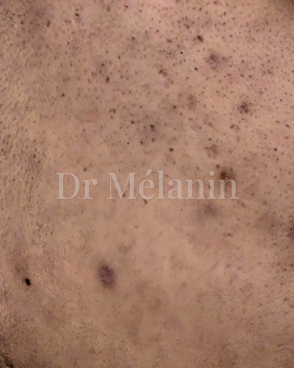 Cheek before treatment, with dark marks, congestion and acne scarring