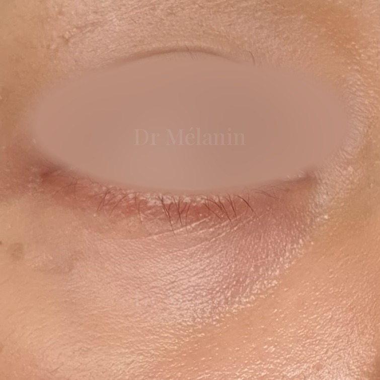 The same under-eye area six months later, with firmer skin and less visible darkness