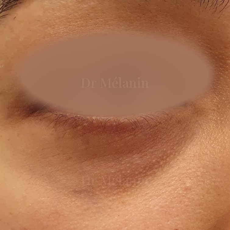 Under-eye area before treatment, with noticeable darkness and hollowing