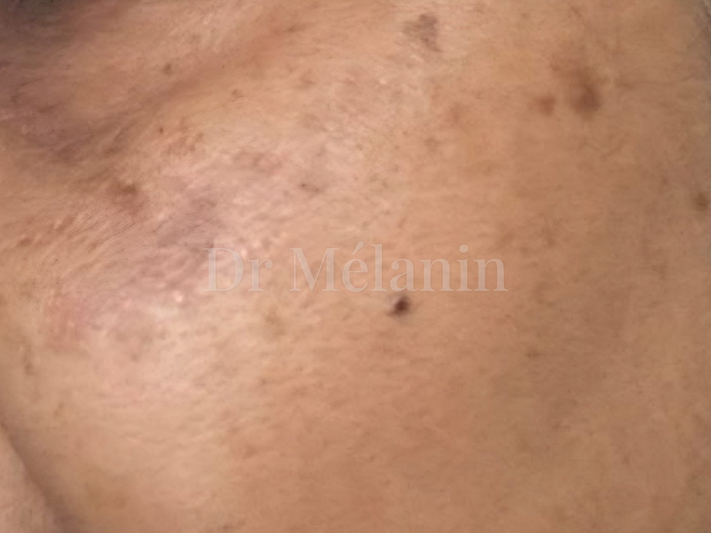 The same cheek after three months of topical treatment, with lighter, more even pigmentation