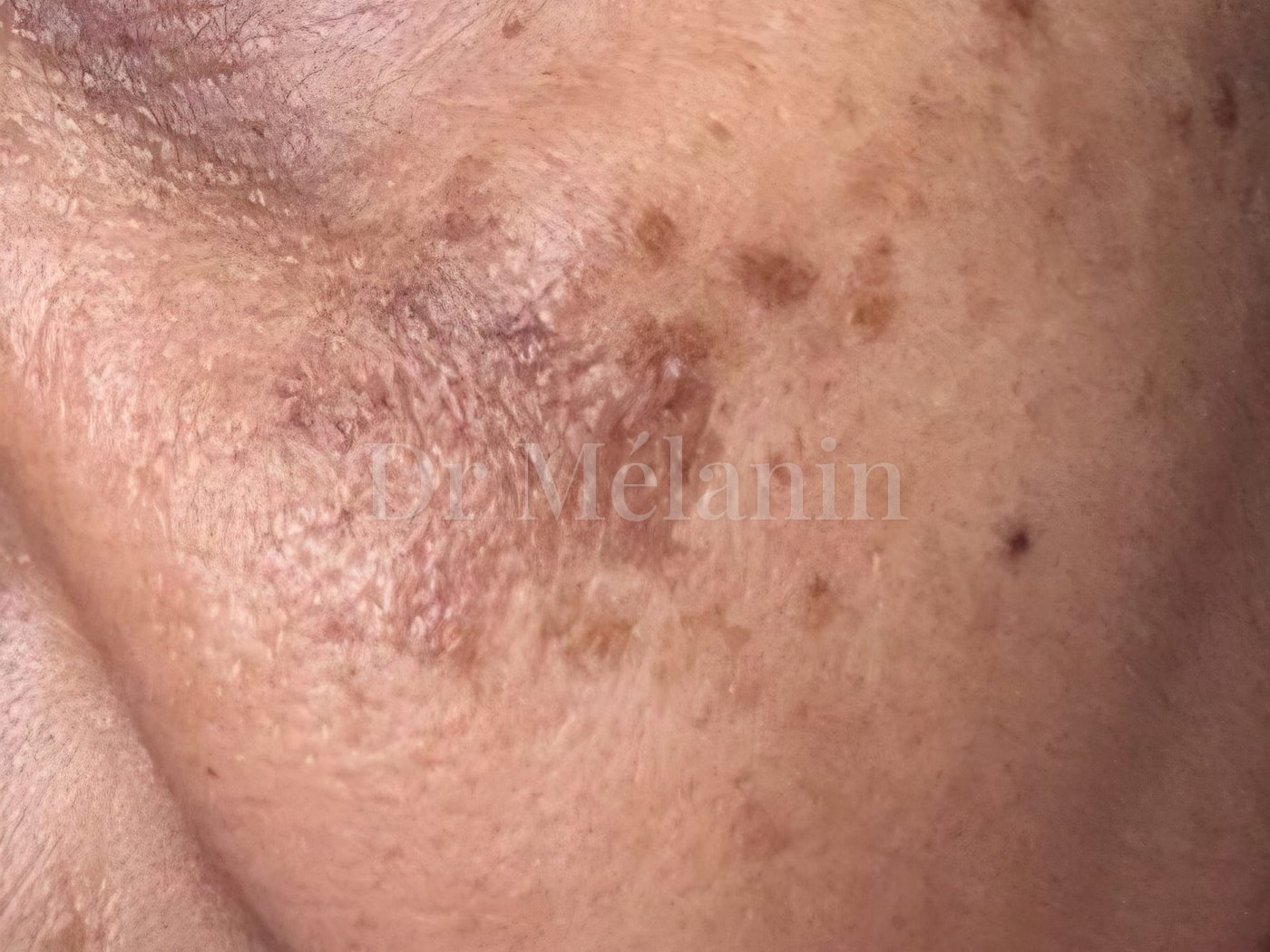 Cheek before treatment, with patches of melasma and uneven pigmentation