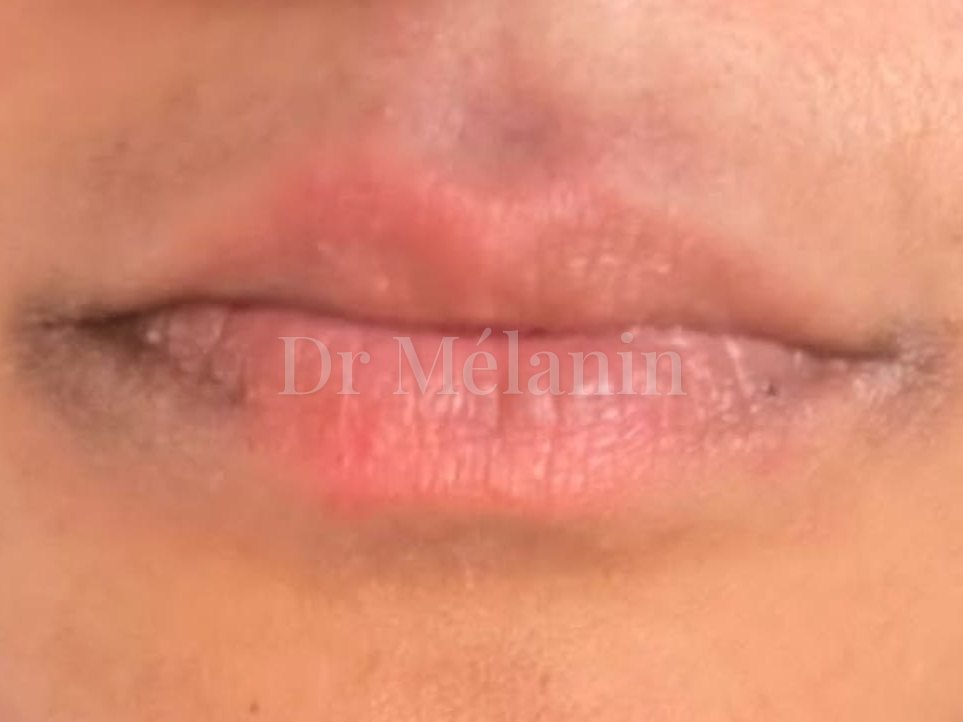 The same area after six weeks, with calmer, smoother skin around the mouth