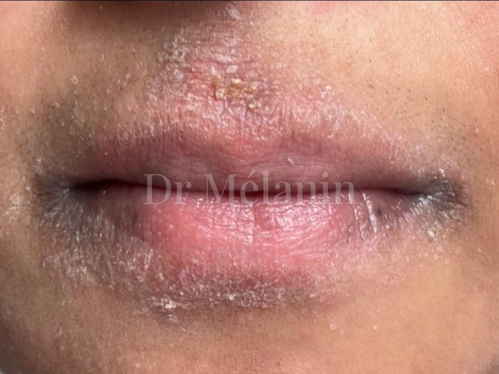 Skin around the mouth before treatment, with redness, scaling and irritation